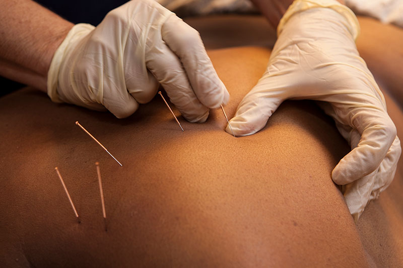 a practitioner performing dry needling on a client